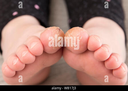 Close-up view of 4 year old child girl with cracks on her big toes. Bad skin condition concept. Stock Photo