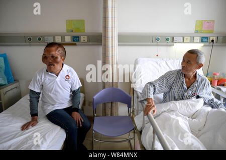 Chinese villager Xia Yuanhai, left, who has an alien-like deformed face, sits in a ward at Chongqing Xinqiao Hospital in Chongqing, China, 25 October Stock Photo