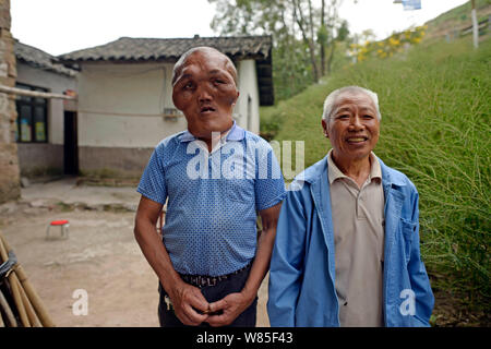 Chinese villager Xia Yuanhai, left, who has an alien-like deformed face posess with his elder brother Xia Yuanchang at home in Laotu village, Changlin Stock Photo