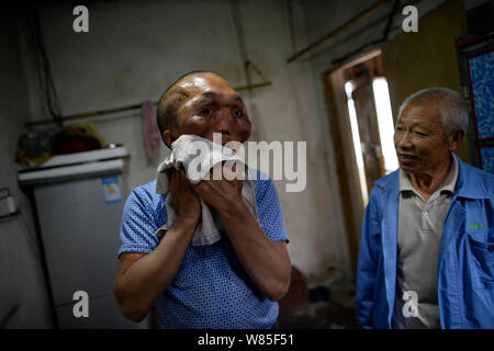 Chinese villager Xia Yuanhai, left, who has an alien-like deformed face washes his face next to his elder brother Xia Yuanchang at home in Laotu villa Stock Photo