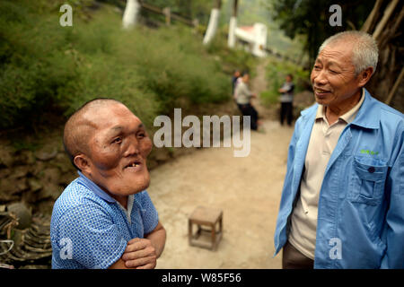 Chinese villager Xia Yuanhai, left, who has an alien-like deformed face talks with his elder brother Xia Yuanchang near home in Laotu village, Changli Stock Photo