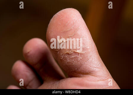 A skin disorder called Callus occurs on feet toe closeup. Stock Photo