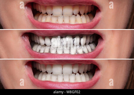 Close-up Detail Of Smiling Woman Teeth Before And After Cleaning With Charcoal Toothpaste Stock Photo