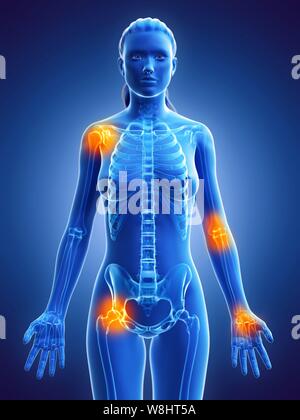 Joint pain, conceptual computer illustration. Stock Photo