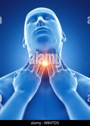 Sore throat, conceptual computer illustration. Stock Photo