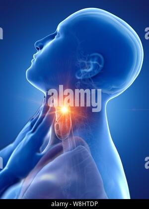 Sore throat, conceptual computer illustration. Stock Photo