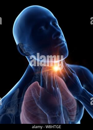 Sore throat, conceptual computer illustration. Stock Photo