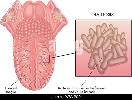 Medical illustration of a cause of halitosis Stock Vector