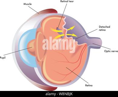 Medical illustration of the effects of the retinal detachment Stock Vector