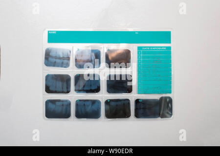 Diagnosis of diseases scan of the teeth. an orthopantomogram isolated on white Stock Photo