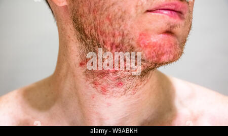 Detail of the man's chin with seborrheic dermatitis in the beard area ...