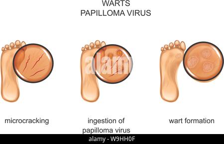 vector illustration of warts on the sole Stock Vector