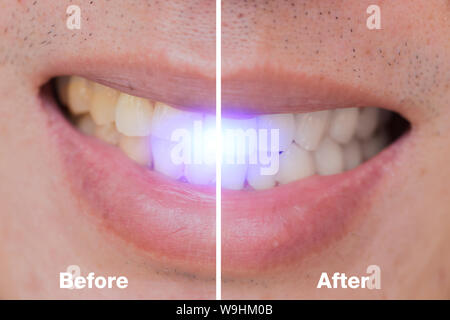 Before and After of dental bleaching in male whitening teeth for remove coffee or cigarette stains. Stock Photo