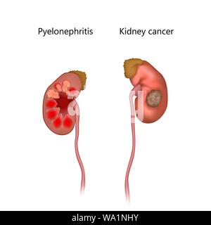 Illustration of inflamed kidneys Stock Photo - Alamy