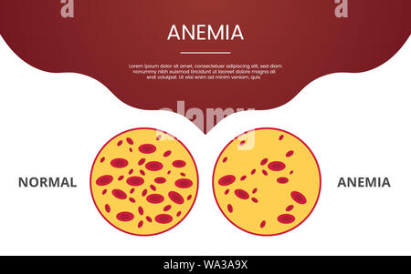 Anemia and anaemia medical diagram concept as normal and abnormal blood ...