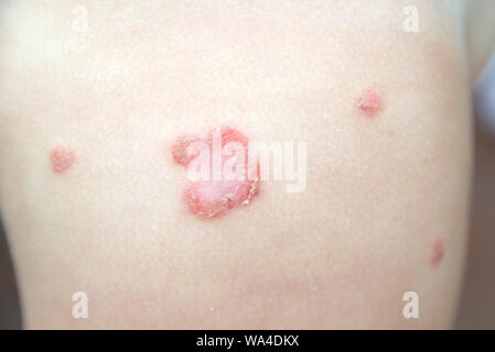Contagious bacterial dermatologic infection impetigo on a child skin without pharmacologic treatment. Macro shot with empty copy space Stock Photo