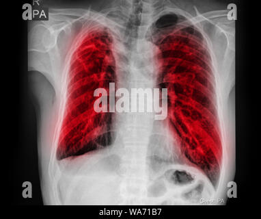 Pulmonary Tuberculosis ( TB ) : Chest x-ray show alveolar infiltration at both lung due to mycobacterium tuberculosis infection. Stock Photo