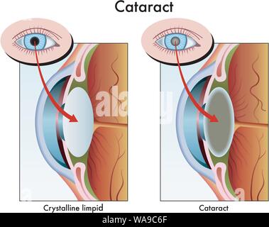 Medical illustration of the effects of cataract. Stock Vector