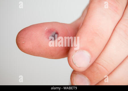 Blood blister under the thumb skin. Caucasian young man finger on white background Stock Photo