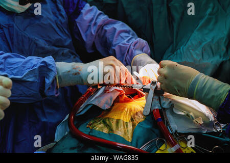 Suture of an lung emphysema surgery in an infant andmedical assistance close-up Stock Photo