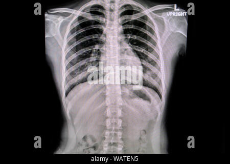 Chest x-ray film taken to examine the heart. Stock Photo