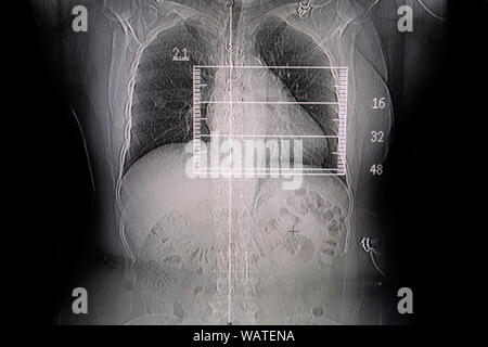 Set chest x-ray film taken to examine the heart. Healthcare and Medical concept. Stock Photo