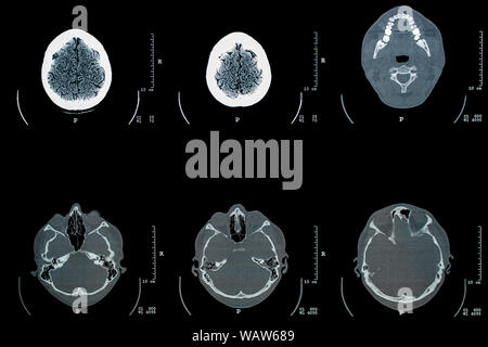 tomographic examination x-ray picture of a human head Stock Photo