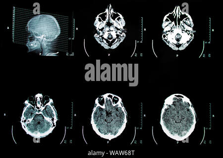 tomographic examination x-ray picture of a human head Stock Photo