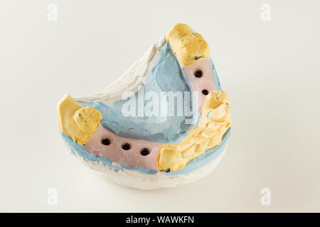 dental plaster model with artificial analogues of dental implants Stock Photo