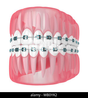 3d render of jaw with teeth and orthodontic braces  isolated over white background Stock Photo