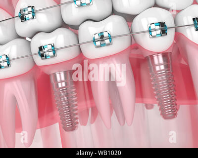 3d render of jaw with implants and orthodontic braces isolated over white background Stock Photo