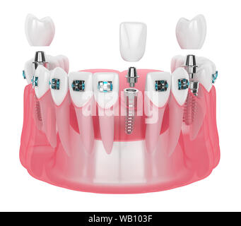 3d render of jaw with implants and orthodontic braces isolated over white background Stock Photo