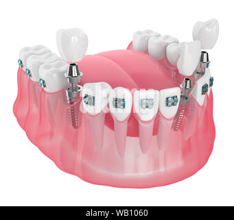 3d render of jaw with implants and orthodontic braces isolated over white background Stock Photo