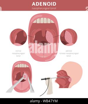 Nasal and throat, nasopharynx diseases. Adenoids diagnosis and treatment medical infographic design. Vector illustration Stock Vector