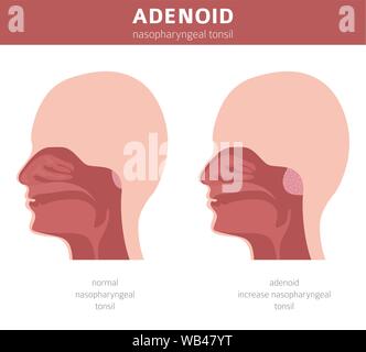 Nasal and throat, nasopharynx diseases. Adenoids diagnosis and treatment medical infographic design. Vector illustration Stock Vector