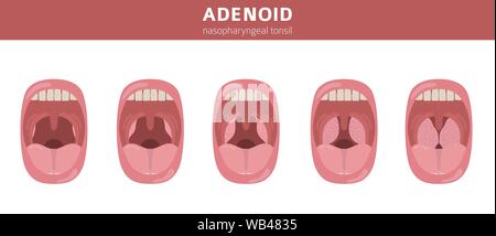 Nasal and throat, nasopharynx diseases. Adenoids diagnosis and treatment medical infographic design. Vector illustration Stock Vector