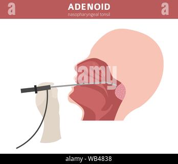 Nasal and throat, nasopharynx diseases. Adenoids diagnosis and treatment medical infographic design. Vector illustration Stock Vector