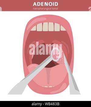 Nasal and throat, nasopharynx diseases. Adenoids diagnosis and treatment medical infographic design. Vector illustration Stock Vector