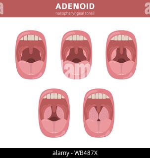 Nasal and throat, nasopharynx diseases. Adenoids diagnosis and treatment medical infographic design. Vector illustration Stock Vector