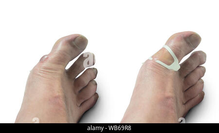 Close-up of man's foot with a large blister filled with bloody fluid on the inside of the foot and the foot with a gel band aid applied after draining Stock Photo