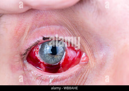 postoperative heavy inflamed eye closeup shot with selective focus and blur Stock Photo