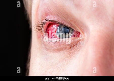 postoperative heavy inflamed eye closeup shot with selective focus and blur Stock Photo