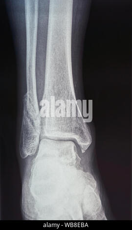 Bone scan of a foot Stock Photo