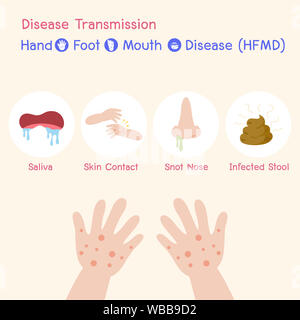Disease Transmission the Disease virus baby Children infected have a Blister Hand Foot Mouth Disease, HFMD in rain season, Medical Health care concept