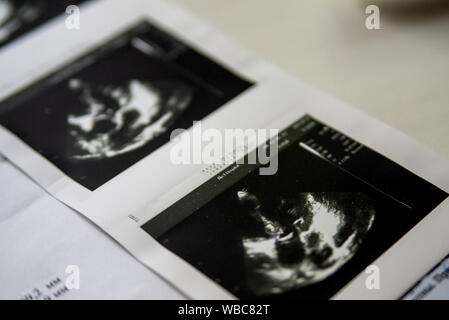 Image of Heart ultrasound with health danger printed on paper. Stock Photo