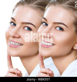 Beautiful woman smiling with perfect teeth before and after braces. Isolated on white. Stock Photo