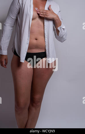 Woman body with serious sunburn damage to skin. Stock Photo