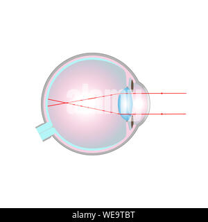 Vision disorder, illustration. Short-sightedness (myopia) corrected ...