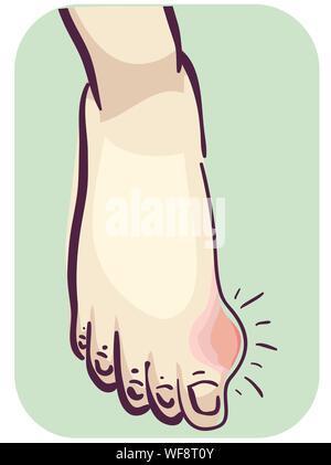 Illustration of a Foot with Lump Near Thumb. Gout Symptom Stock Photo