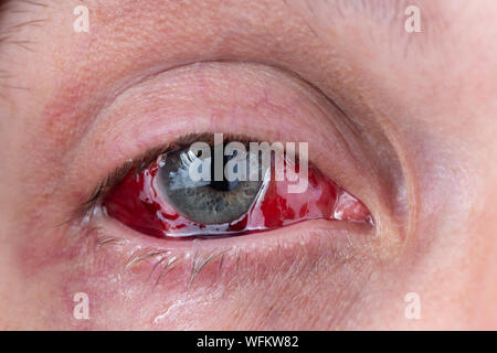 postoperative heavy inflamed eye closeup shot with selective focus and blur Stock Photo